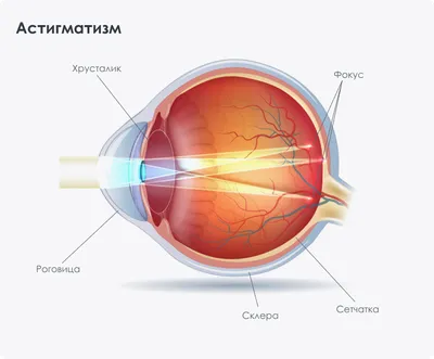 Коротко про астигматизм - Контактна корекція зору - оптика, контактні  лінзи, окуляри, діагностика та підбір