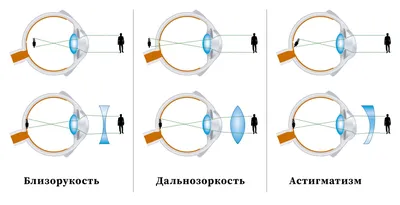 Лечение астигматизма в СЗАО (м.Щукинская, м.Стрешнево, м.Сокол)