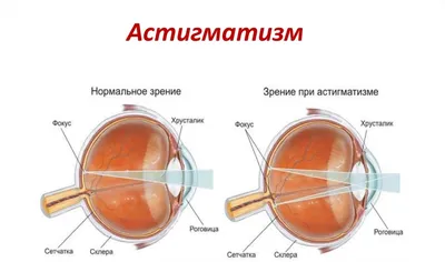 Астигматизм- что-это-такое