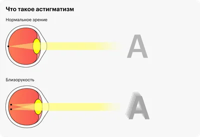 Астигматизм – причины, симптомы, коррекция | Acuvue