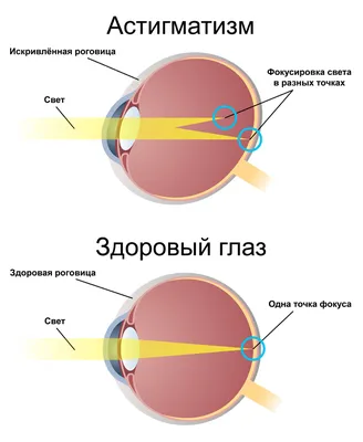 АСТИГМАТИЗМ и БЛИЗОРУКОСТЬ - отличие, разница между болезнями