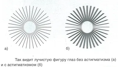 Астигматизм – причины, симптомы, коррекция | Acuvue