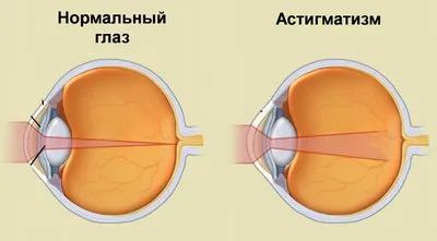 Просто и доступно про астигматизм | Заброшенный дневник | Дзен