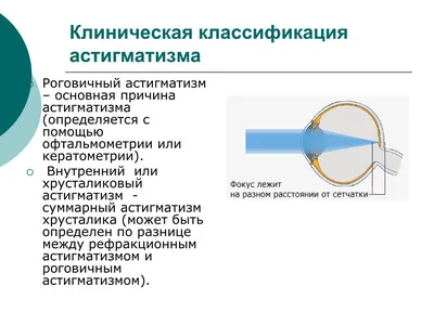 Очки при астигматизме и близорукости - энциклопедия Ochkov.net