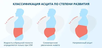 Асцит брюшной полости: причины возникновения, симптомы и лечение