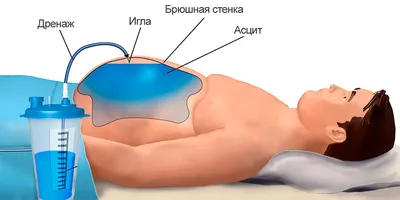 Лечение асцита при циррозе печени в Санкт-Петербурге - цена