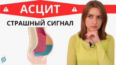 АСЦИТ.Случай из практики. Начинала я свой трудовой путь на Родине,❤️в  тяжелом соматическом терапевтическом отделении…🙈 Насмотрелась… | Instagram