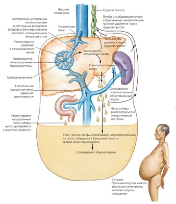 Цирроз печени - симптомы, признаки, стадии и лечение