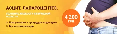 Клинический случай асцита неясного генеза – тема научной статьи по  клинической медицине читайте бесплатно текст научно-исследовательской  работы в электронной библиотеке КиберЛенинка