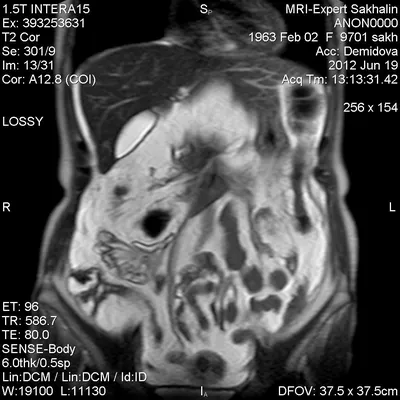 PDF) [Ascites, spontaneous bacterial peritonitis, hepatorenal syndrome:  What is common in their diagnosis and treatment?]