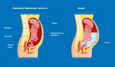 Жидкость в брюшной полости - причины появления, при каких заболеваниях  возникает, диагностика и способы лечения