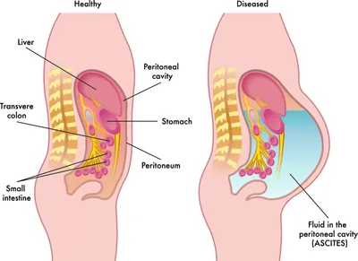 Асцит – причины, симптомы и лечение, профилактика | Ниармедик
