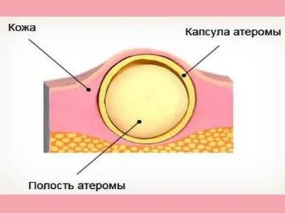 Удаление атеромы лазером в Санкт-Петербурге