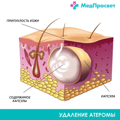 Удаление атеромы - «Шрам на память о моей медлительности.» | отзывы