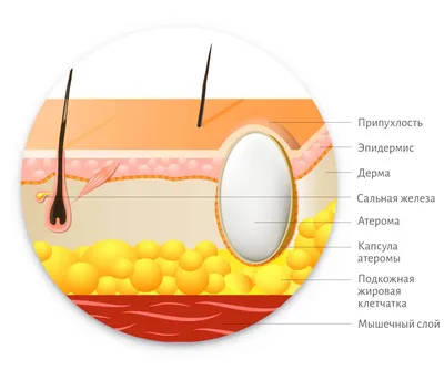 Атерома - кистозное образование, возникающее в результате закупорки протока  сальной железы. Чаще всего атеромы появляются на… | Медицинский, Лицо,  Медицинский центр