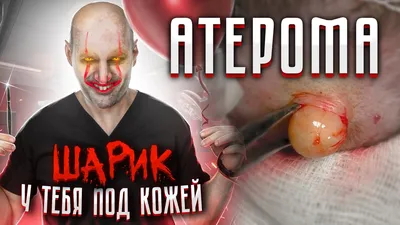 Лазерное удаление атером - Клиника Аврора в Краснодаре | Официальный сайт