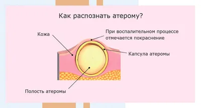 Когда снимают швы после хирургической операции по удалению атеромы —  клиника «Добробут»