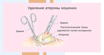 Атерома мошонки: симптомы и лечение атеромы на яичках и половом члене в  Москве