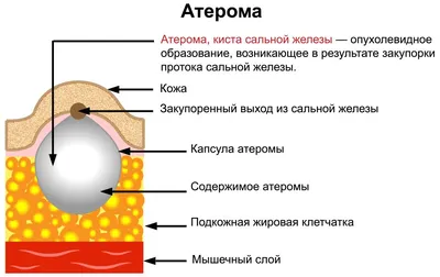 Атерома. Лечение в Ташкенте В многопрофильной клинике «Gatling-med»