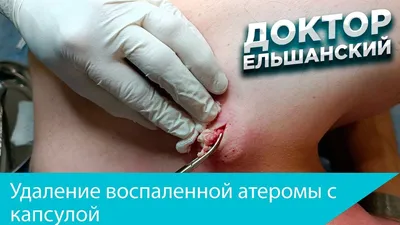 Атерома нагноившаяся - диагностика и лечение в Москве. Консультация врача.