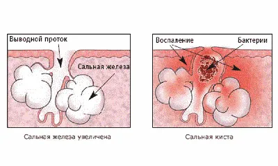 Атерома уха: лечение в МЦ Лазерсвiт