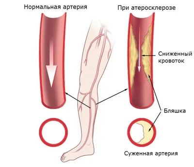 Атеросклероз нижних конечностей фото