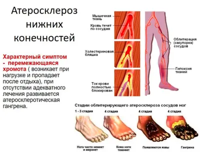 Атеросклероз нижних конечностей - лечение в ММЦ Святослава Федорова в Москве