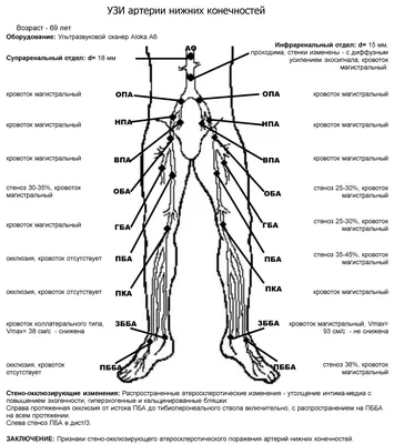 Атеросклероз нижних конечностей - Инновационный сосудистый центр