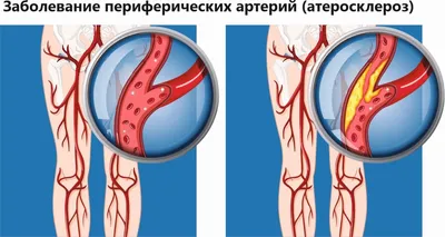 Облитерирующий атеросклероз | Клиника доктора Огневой «ЛАЗЕРНЫЙ ЦЕНТР»