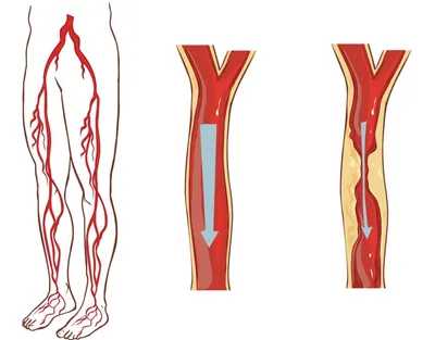 Атеросклероз сосудов (артерий) нижних конечностей (ног): лечение, симптомы,  клинические рекомендации