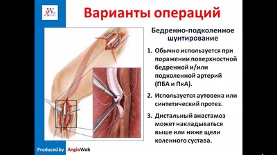 Облитерирующий атеросклероз — (клиники Di Центр)