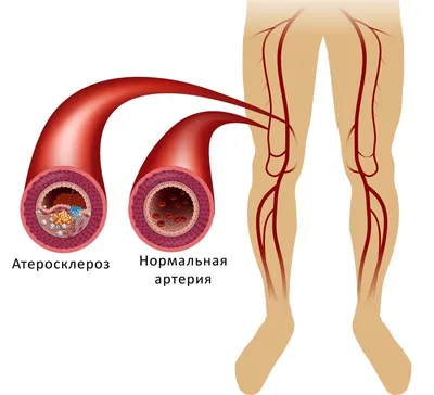 Атеросклероз сосудов нижних конечностей: причины, симптомы и лечение в  статье сосудистого хирурга Мурасов Т. М.
