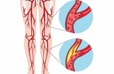 Лечение атеросклероза нижних конечностей в Харькове