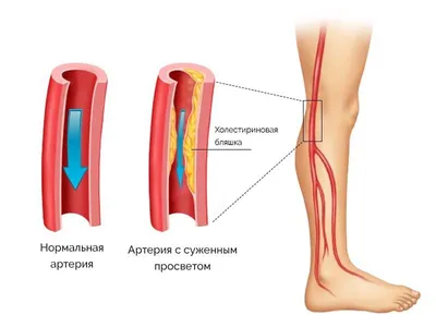 Атеросклероз артерий нижних конечностей лечение - Москва