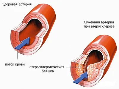 Атеросклероз нижних конечностей