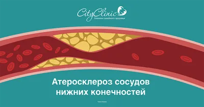 Атеросклероз артерий нижних конечностей: причины, симптомы и лечение |  Здоровье сердца | Дзен