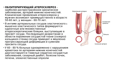 Варикоз на ногах и атеросклероз нижних конечностей: симптомы, причины,  профилактика