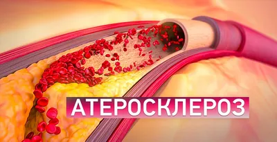 Облитерирующий атеросклероз нижних конечностей