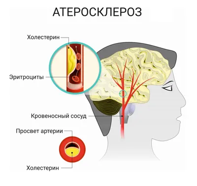 Атеросклероз брюшной аорт | Презентации Терапия | Docsity