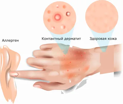 Атопический дерматит: почему возникает и как лечить? - VITAE