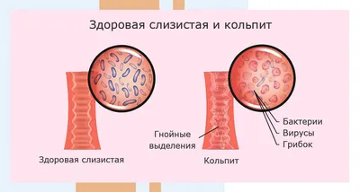 Гинекологическое заболевание кольпит - причины воспаления, симптомы,  диагностика и лечение в клинике АльтраВита