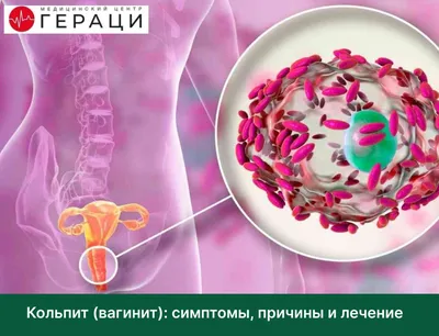 Кольпит: симптомы и диагностика 🌺 – Юнона