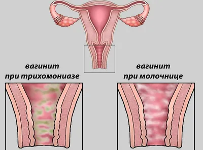 Кольпит • Купить препараты при кольпите • Кольпит лекарства в аптеке  Подорожник: Киев, Днепр, Харьков, Одесса, Львов