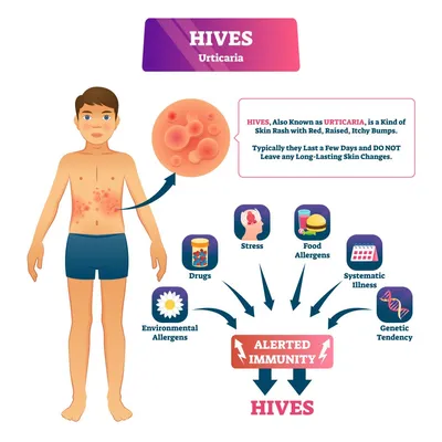 Крапивница – причины, симптомы, диагностика и способы лечения заболевания |  Клиника Будь Здоров