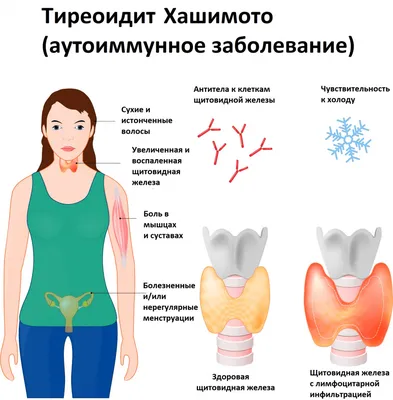 Крапивница у взрослых: лечение, симптомы, причины