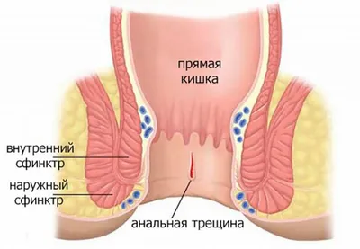 Часто встречается и другое заболевание заднего прохода – анальная трещина  (особенно у женщин). Она почти всегда появляется на фоне… | Instagram