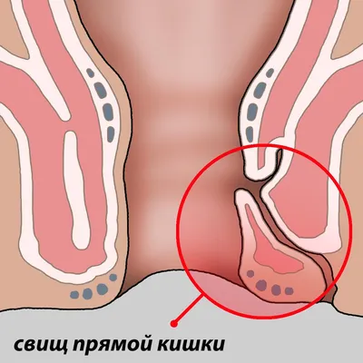 Анальная бахромка осложненная тромбозом. Как удаляют? Проктологическая  операция в клинике Наука. - YouTube