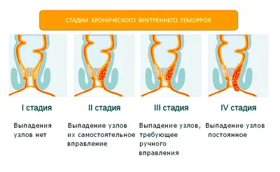 Геморроидальный тромбоз или «шишка» в области ануса - KP.RU