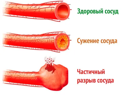 Анальные бахромки: заболевание или эстетический дефект? - KP.RU