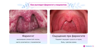 Фарингит лечение симптомы, как лечить фарингит - блог Furasol®